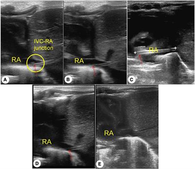 Point-of-care ultrasound for monitoring catheter tip location during umbilical vein catheterization in neonates: a prospective study